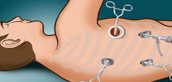 Paediatric Thoracoscopy Paediatric Thoracoscopy